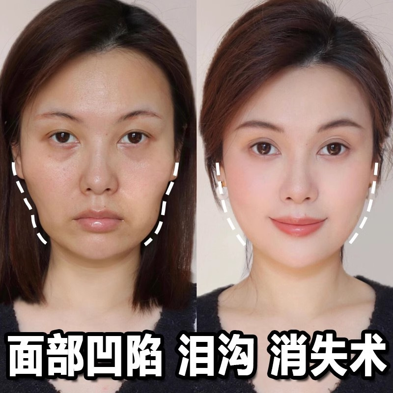 Facial plumping serum, beauty salon temple tear trough supplement, facial plumping essence, genuine wholesale original solution